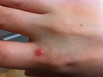 What Does A Cockroach Bite Look Like Bite Marks Picture