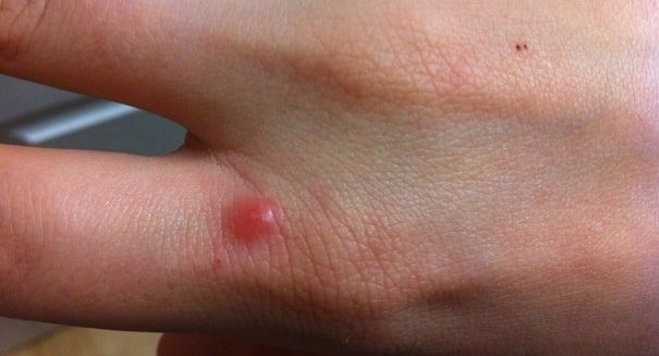 american cockroach bite