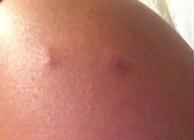 what does a roach bite look like
