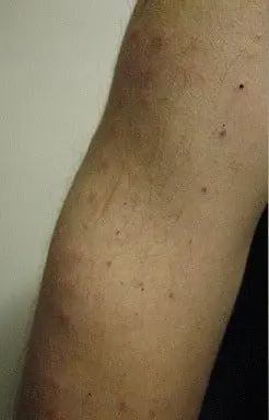 cockroach allergy symptoms treatment amp prevention rash cockroach allergy